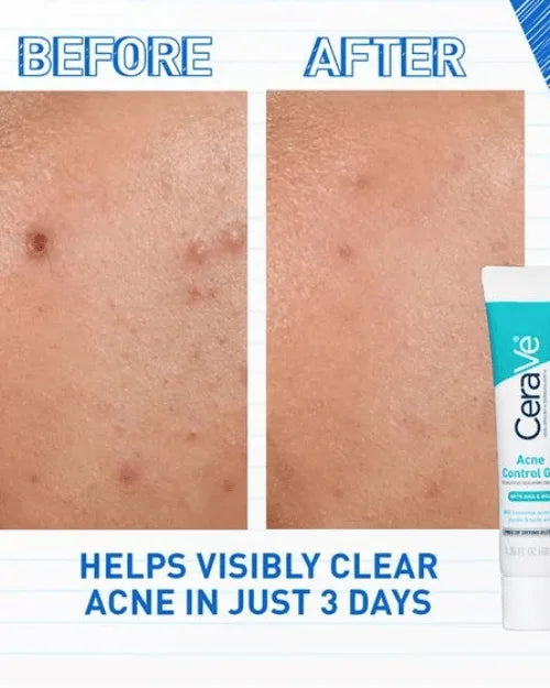 CERAVE | ACNE CONTROL GEL